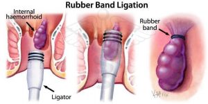 rubber-band-ligation