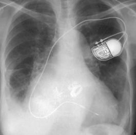Module Pacemaker/ICD