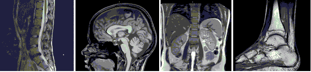 MRI