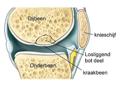 Osteochondritis Dissecans (Od) Van De Knie - Medisch Spectrum Twente
