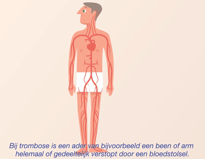 Uitleg over wat trombose is