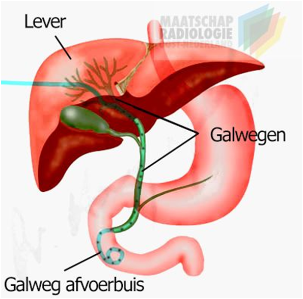 Galdrainage (PTCD) Medisch Spectrum Twente