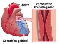 vernauwde-ader