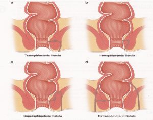 peri-anale-fistel